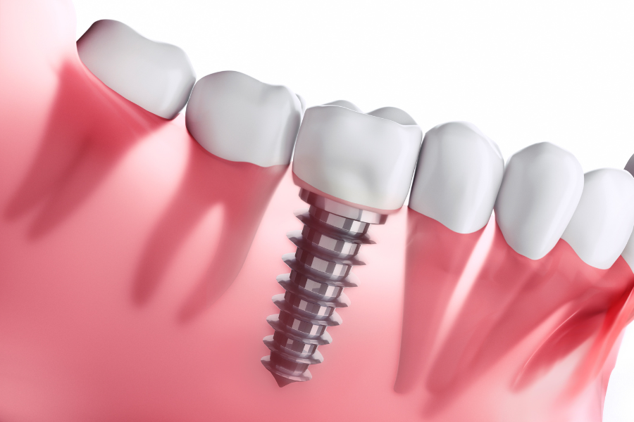 Cấy Ghép Implant Cho Người Lớn Tuổi 