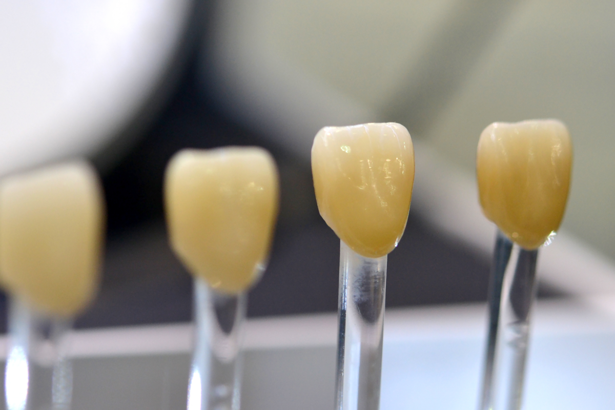 Top 10 Hậu Quả Bọc Răng Sứ Giá Rẻ