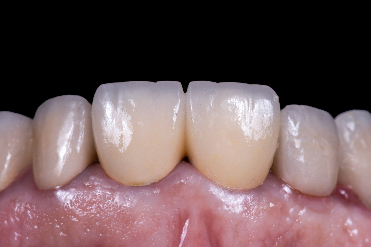 Top 10 Hậu Quả Bọc Răng Sứ Giá Rẻ