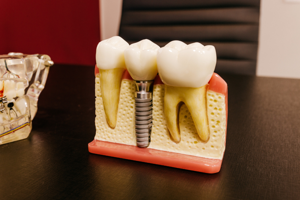 8 Lưu Ý Không Thể Bỏ Qua Khi Trồng Răng Implant